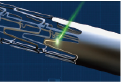 stent cutting metal